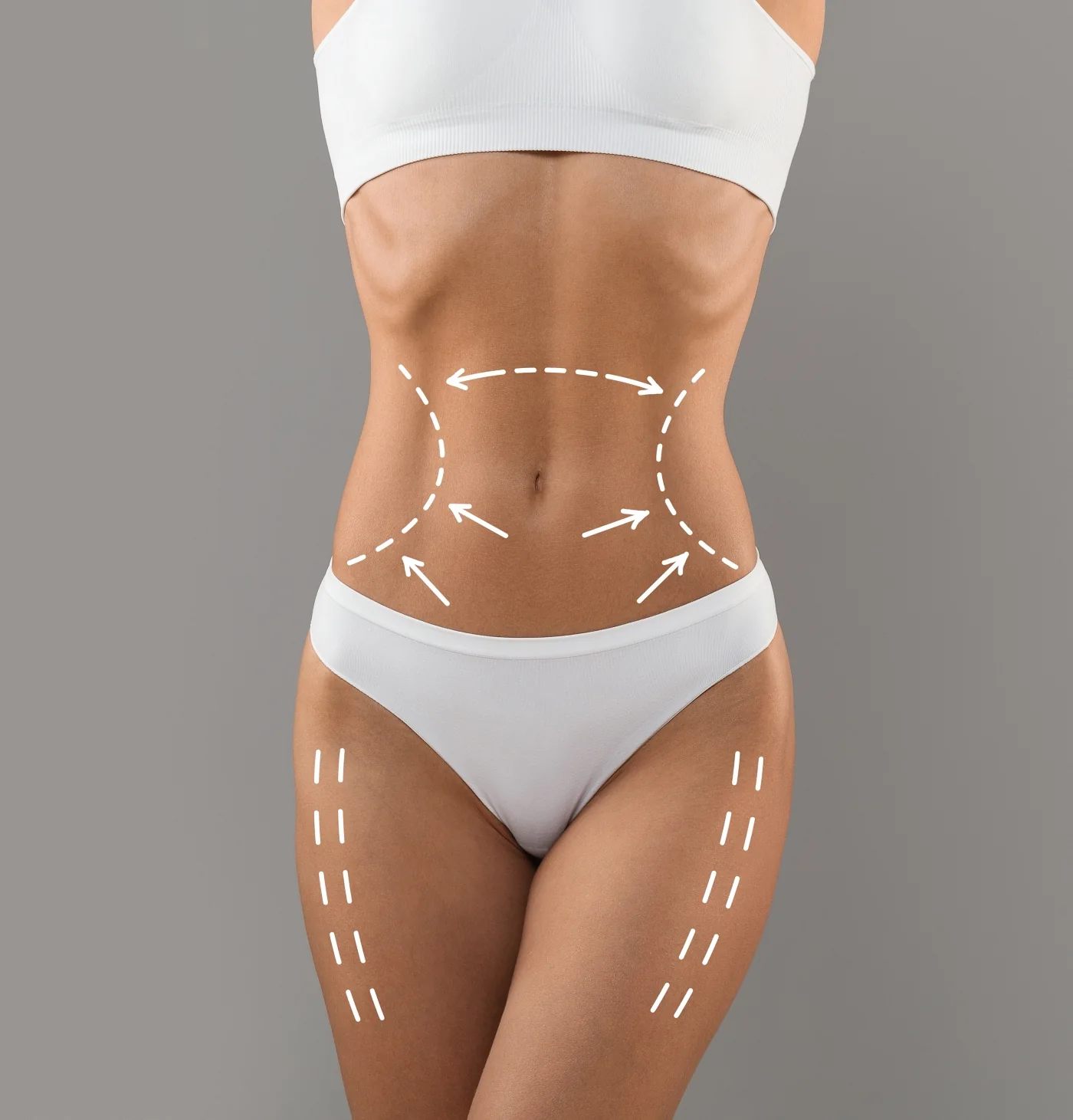 BodyTite: The Science Behind Radio-Frequency Lipolysis (RFAL)